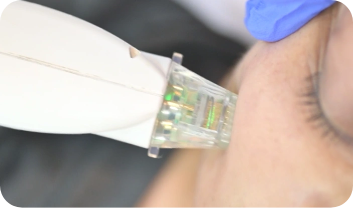 Under-eye rejuvenation and tightening with NeoiRejuve and Microneedling treatment