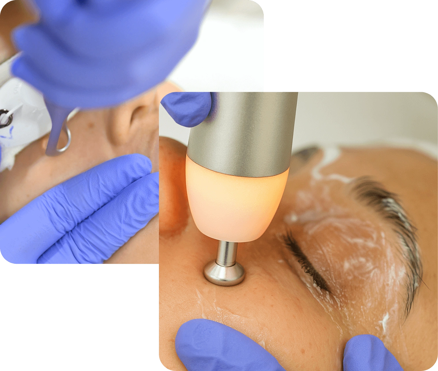 NeoiRejuve Advanced RF technology for under-eye